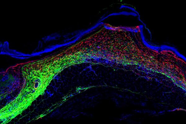 Skin fascia matrix and inflammatory fascia fibroblasts in wounds, Dongsheng Jiang