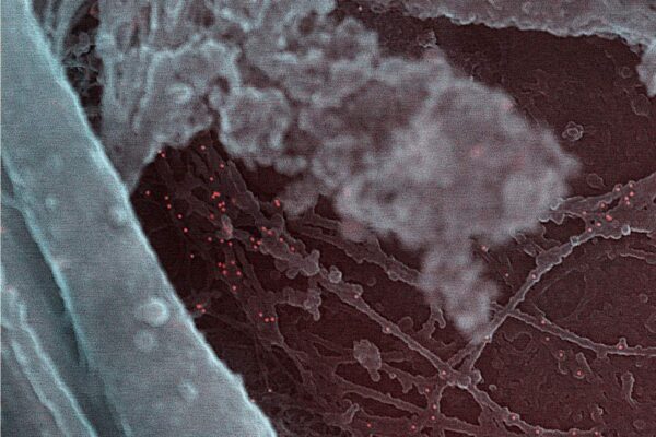 Laser scanning microscopy image of cell surface vimentin on human senescent chondrocyte, Jana Riegger-Koch