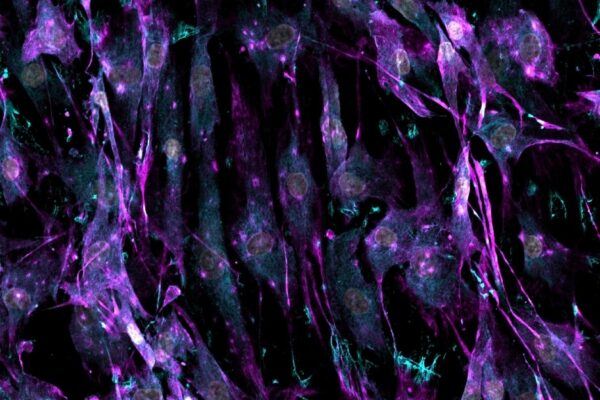 Catalyzing cellular alchemy - CTGF elicits the transmutation of human MSCs into a fibrotic fibroblast phenotype, Alexandra Damerau